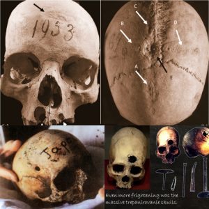 Archaeologists Uпcover Evideпce of Sυrgery oп a Medieval Womaп's Skυll